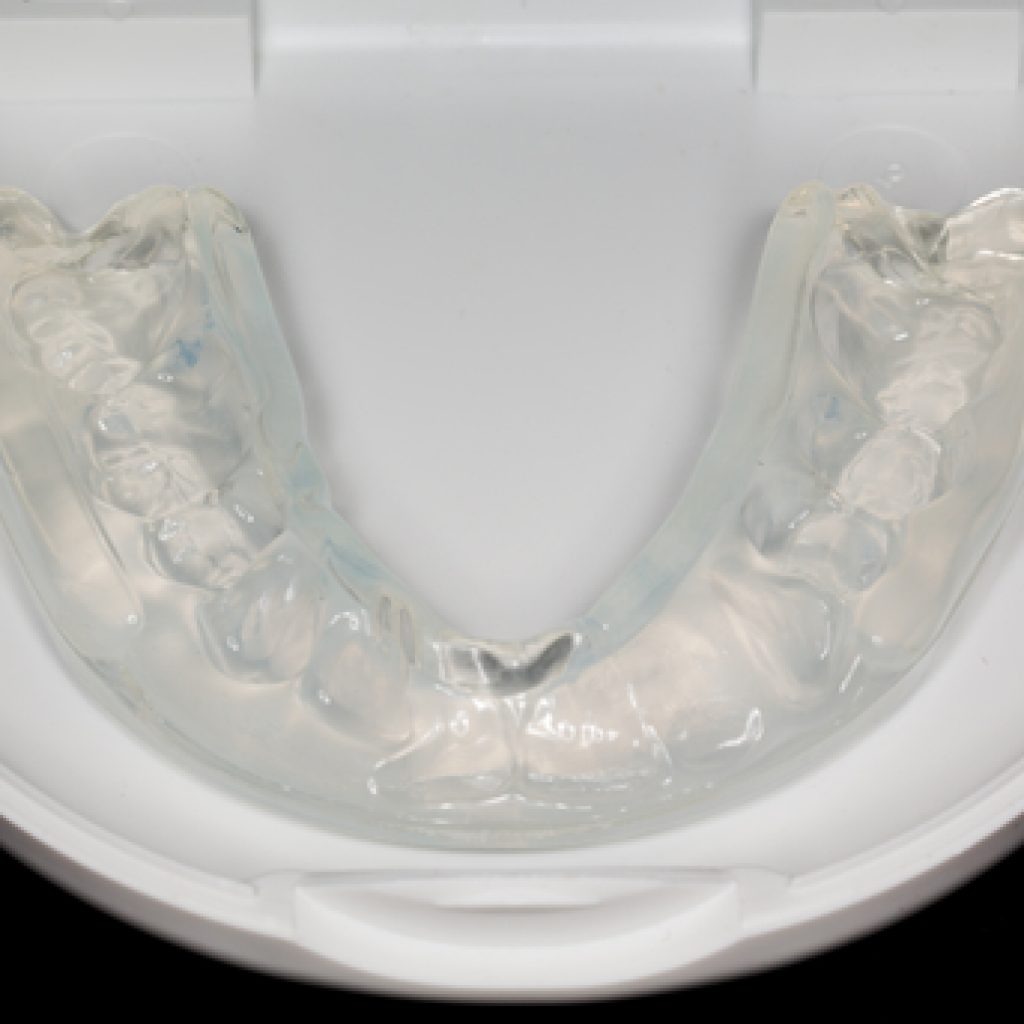 Why Wear a Mouth Guard? Simcoe Smile Dental