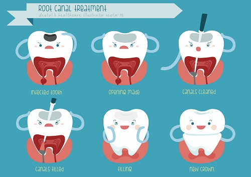 Three Root Canal Myths