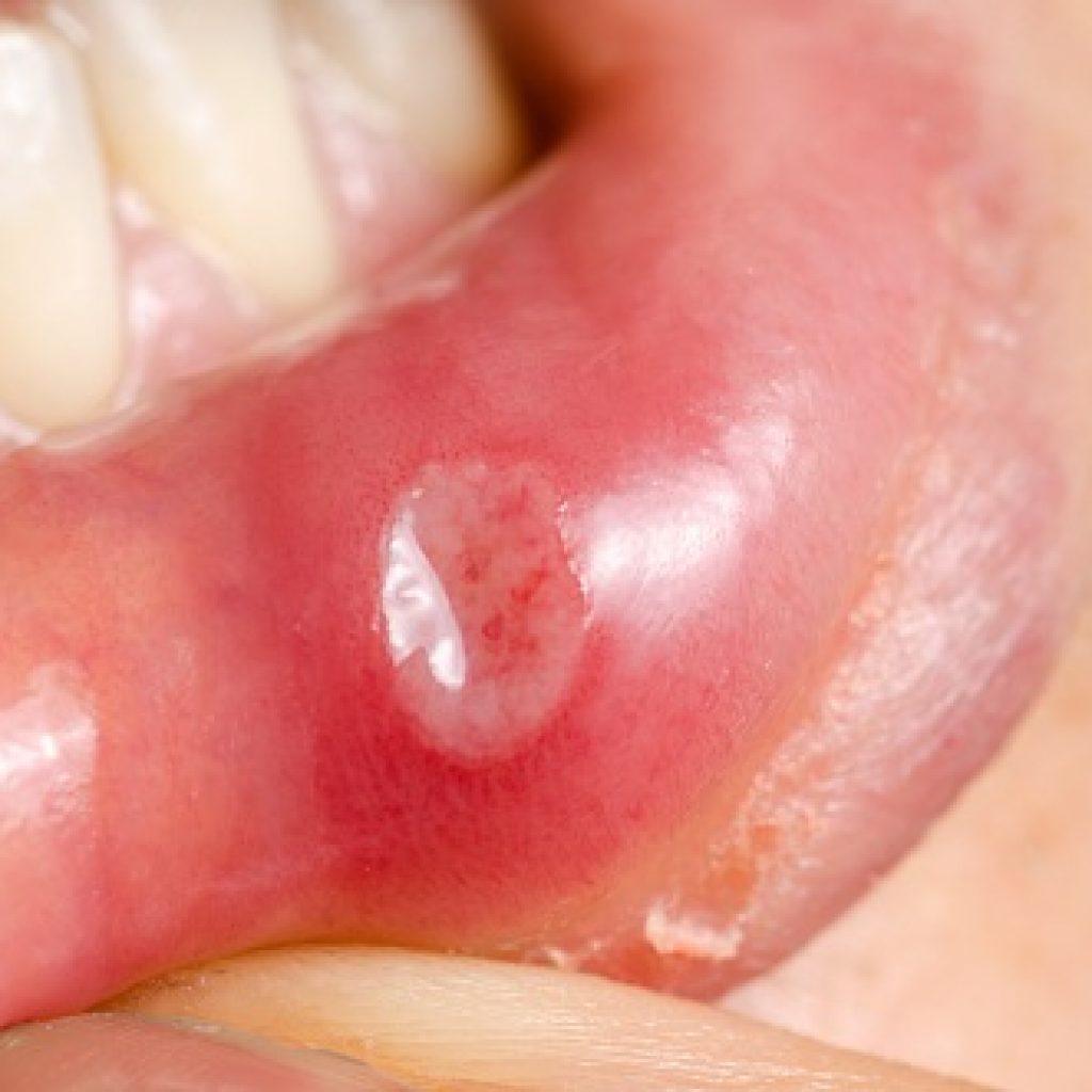 Lessen Canker Sore Irritation During Holiday Eating Simcoe Smile Dental