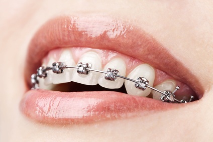 How to Know if Invisalign is Right for You