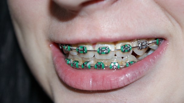 Five Tips for Patients with Braces