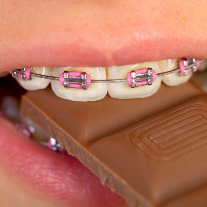 Foods and Habits to Avoid when Wearing Braces