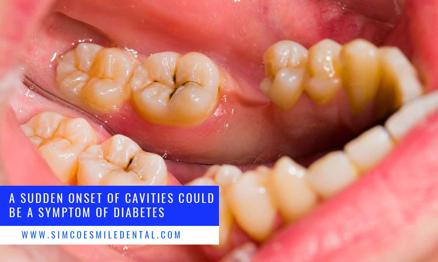 A sudden onset of cavities could be a symptom of diabetes.