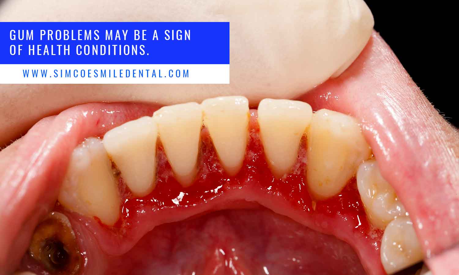 Gum problems may be a sign of health conditions.