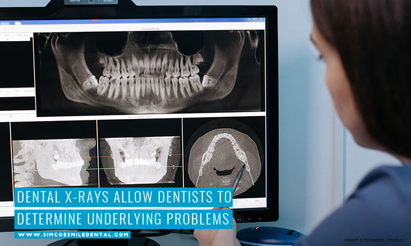 Dental-X-rays-allow-dentists-to-determine-underlying-problems What Does Your Mouth Say About Your Heart Health?
