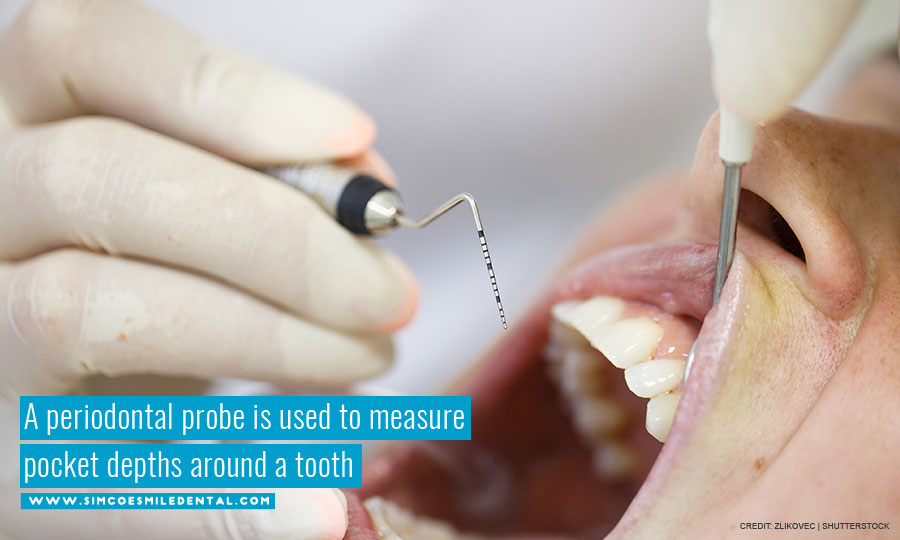A-periodontal-probe-is-used-to-measure-pocket-depths-around-a-tooth Deep Cleaning for Teeth — Do You Need It?