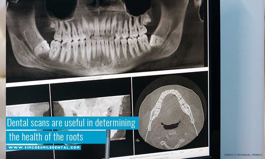 Dental scans are useful in determining the health of the roots