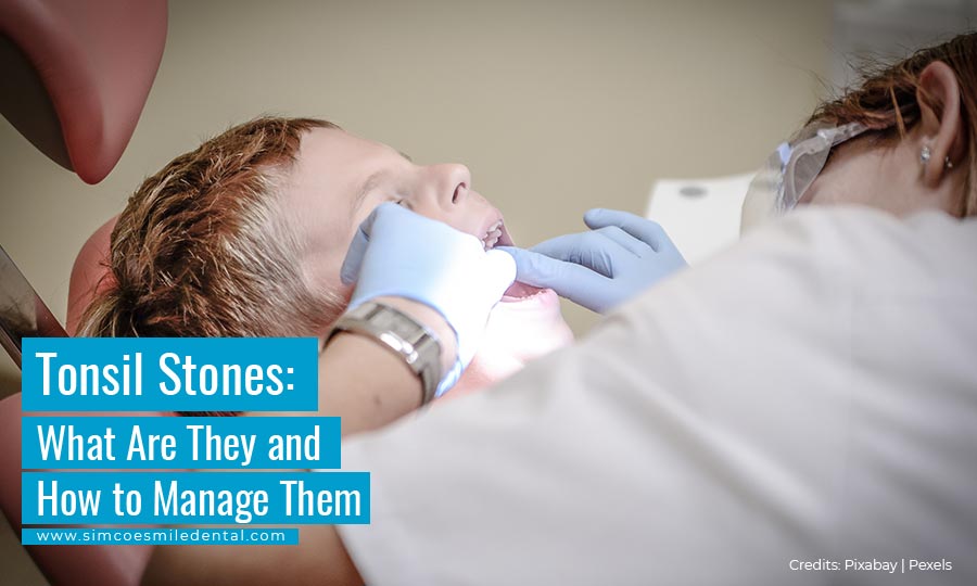 Tonsil Stones: What Are They and How to Manage Them