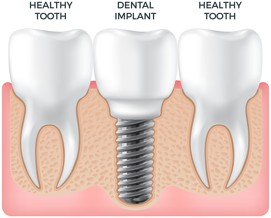 Tooth implant vs. natural tooth