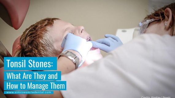 Tonsil Stones: What Are They and How to Manage Them
